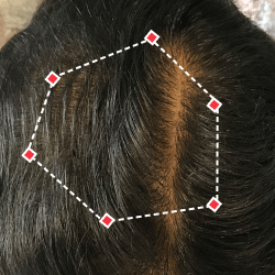 Top down view after image of a man with thicker hair at the frontal region of his hair.