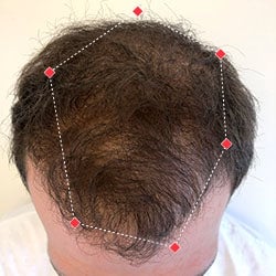 Top down view after image of a man with thicker hair at his crown.