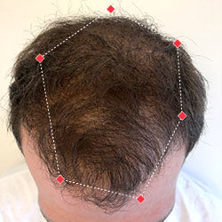 Top down view after image of a man with thicker hair at his crown.