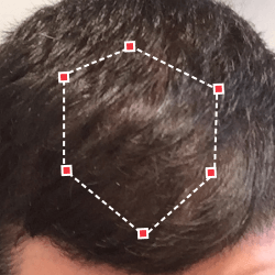 Top down view after image of a man with thicker hair at the frontal region of his hair.