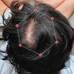 Top down view after image of a man  with thicker hair on his crown.