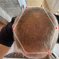 Top down view after image of a man with thicker hair at the crown and frontal region of his hair.