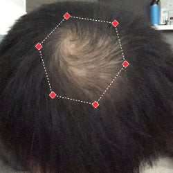 Top down view after image of a man  with thicker hair on his crown.