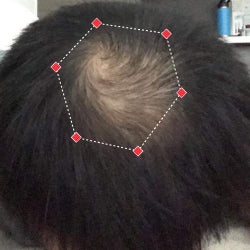 Top down view after image of a man  with thicker hair on his crown.
