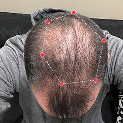 Top down view after image of a man with thicker hair at his crown.