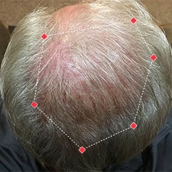 Top down view after image of a man  with thicker hair on his crown.