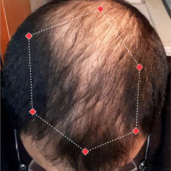 Top down view after image of a man with thicker hair at the crown and frontal region of his hair.