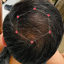 Top down view after image of a man with thicker hair at his crown.