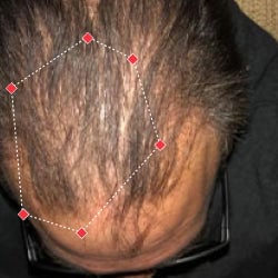 Top down view after image of a man with thicker hair at the frontal region of his hair.