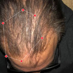 Top down view after image of a man with thicker hair at the frontal region of his hair.