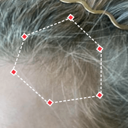 After image of a woman showing the her temples with more thicker hair.