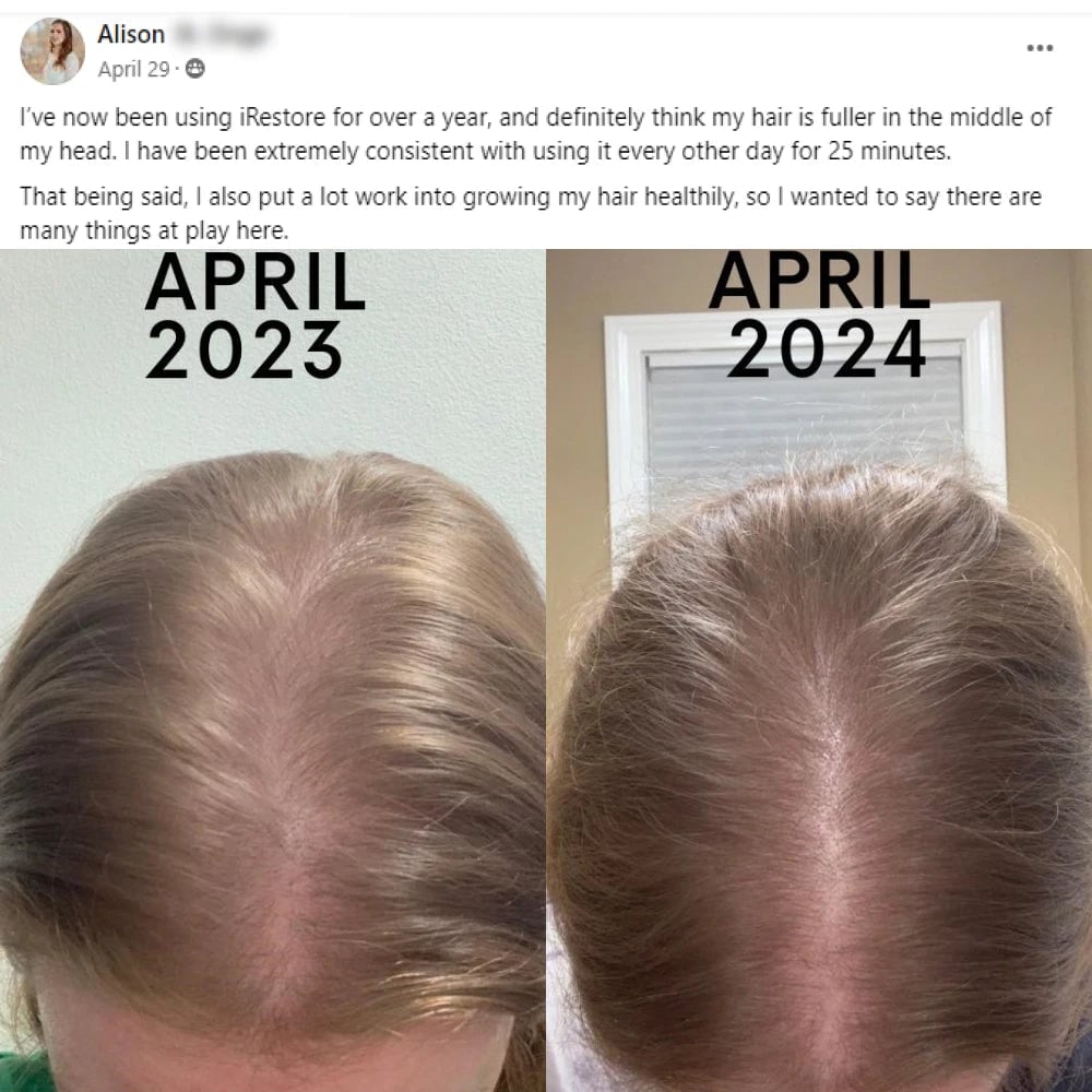 A facebook post from Alison on April 29th. I've now been using iRestore for over a year, and definitely think my hair is fuller in the middle of  my head. I have been extremely consistent with using it every other day for 25 minutes. That being said, I also put a lot work into growing my hair healthily, so I wanted to say there are many things ayt play here. This post shows before and after images with the before showing a thinning hairline of a woman and the after showing the hairline with thicker hair.