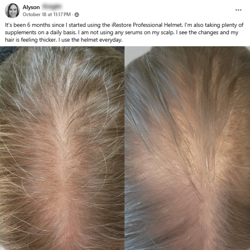 A facebook post from Alyson on October 18th. It's been 6 months since I started using the iRestore Professional Helmet. I'm also taking plenty of supplements on a daily basis. I am not using any serums on my scalp. I see the changes and my hair is feeling thicker. I use the helmet everyday. This post shows before and after images with the before showing a thinning hairline of a woman and the after showing her hairline that got thicker.