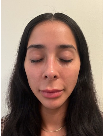 Front view after image of woman with lesser fine lines around smile lines after 8 weeks of usage