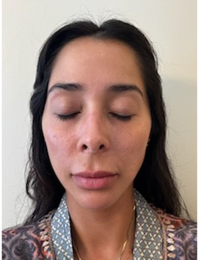 Front view before image of woman with fine lines around smile lines