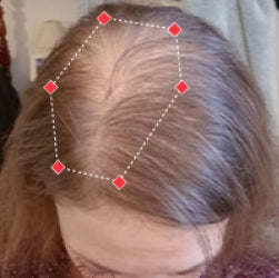 before image showing noticeable hair loss