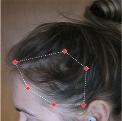 Before image of a woman with thinning hair at her temples.