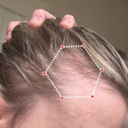 Before image of a woman showing the thinning hair at her temples.