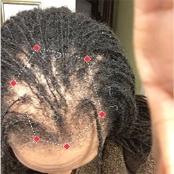 Top down view before image of a woman with thinning hair at the frontal region of her hair.