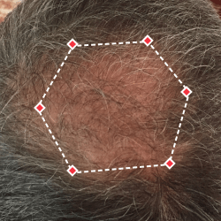 Top down view before image of a man with a thinning hair in his crown.