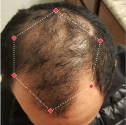 Top down view before image of a man with thinning hair at the crown and frontal region of his hair.