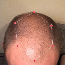 Top down view before image of a man with thinning hair at the crown and frontal region of his hair.