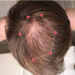 Top down view before image of a man with a thinning hair in his crown.