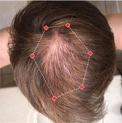 Top down view before image of a man with a thinning hair in his crown.