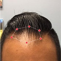 Before image of a man showing his receding hairline.