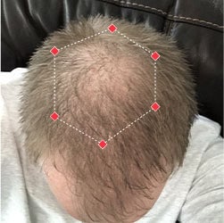 Top down view before image of a man with thinning hair at his crown.