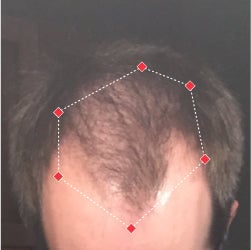 Top down view before image of a man with thinning hair at the frontal region of his hair.