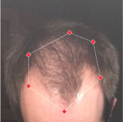 Top down view before image of a man with thinning hair at the frontal region of his hair.