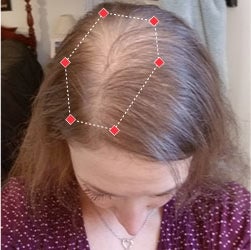 Top down view before image of a woman with thinning hair in her hairline.