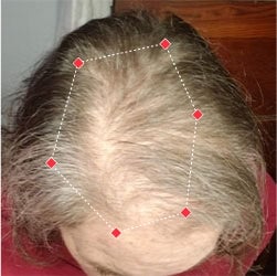 Top down view before image of a woman with thinning hair in her hairline.