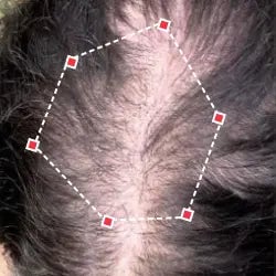 Top down view before image of a woman with thinning hair at the frontal region of her hair.