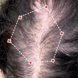 Top down view before image of a woman with thinning hair at the frontal region of her hair.