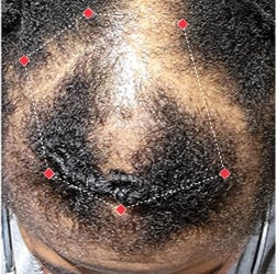 Top down view before image of a woman with thinning bald spots in her crown.