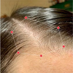 Before image of a woman showing the thinning hair at her temples.
