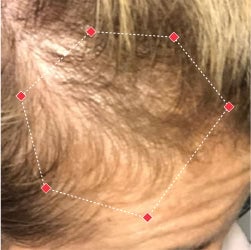 Before image of a woman showing the thinning hair at her temples.