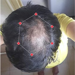 Top down view before image of a woman with thinning hair at her crown.