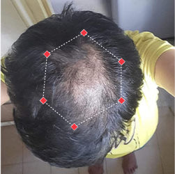 Top down view before image of a woman with thinning hair at her crown.