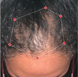 Top down view before image of a woman with thinning hair at the frontal region of her hair.