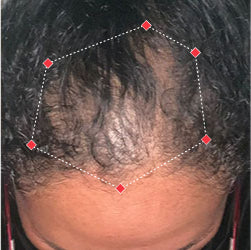 Top down view before image of a woman with thinning hair at the frontal region of her hair.