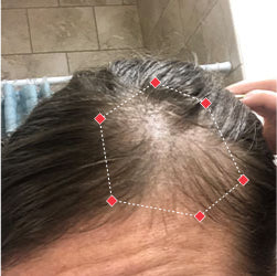 Before image of a woman showing the thinning hair at her temples.