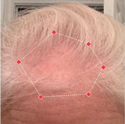 Top down view before image of a woman with bald spot at the frontal region of her hair.