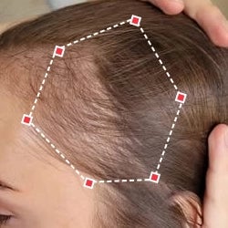 Before image of a woman showing the thinning hair at her temples.