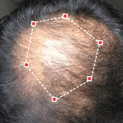 Top down view before image of a man with a thinning hair in his crown.