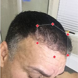 Before image of a man with thinning hair at his hairline.