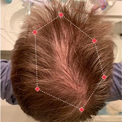 Top down view before image of a man with a thinning hair in his crown.