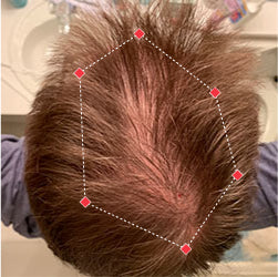 Top down view before image of a man with a thinning hair in his crown.